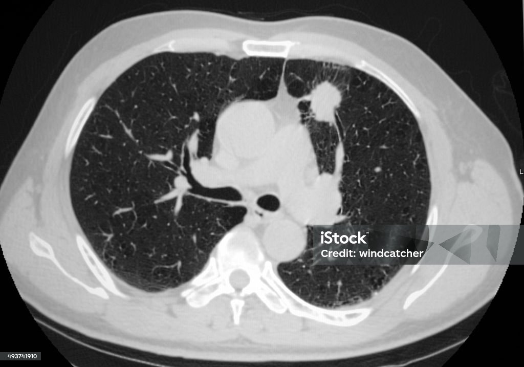 lung cancer thorax CT image thorax and lung computed tomography image:lung cancer. CAT Scan Stock Photo