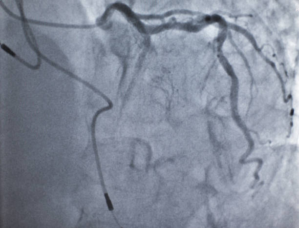 inventional chirurgie bild: herz und kranzschlagader - human heart heart attack x ray image chest stock-fotos und bilder