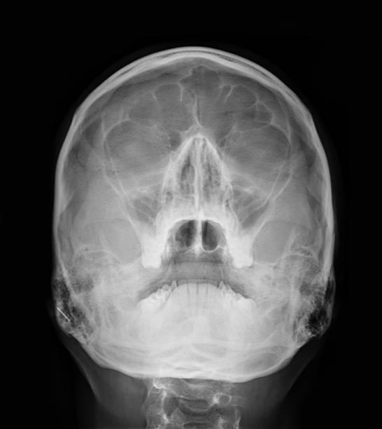 istock X-ray pictures - Sinus 493830627