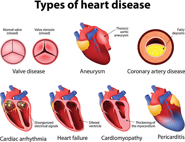 ilustraciones, imágenes clip art, dibujos animados e iconos de stock de enfermedad cardíaca - fibrillation