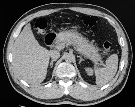 Acute pancreatitis in axial CT image