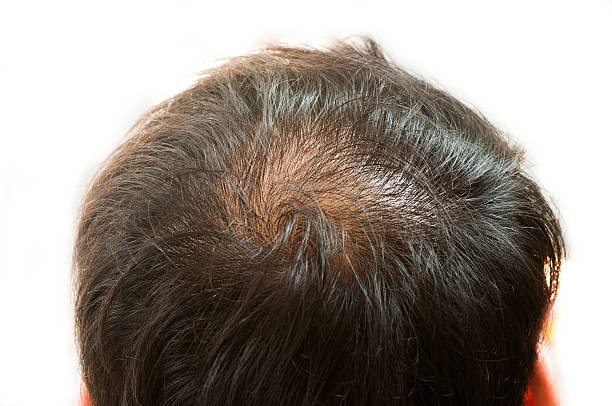 istock Hair loss, thinning hair and scalp 493932464