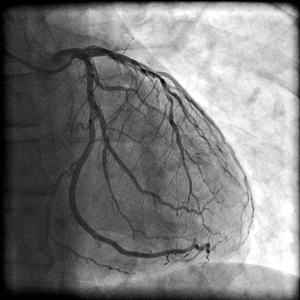 Coronary artery Normal left coronary artery with its branches (left anterior descending and left circumflex coronary arteries) on angiography. coronary artery stock pictures, royalty-free photos & images