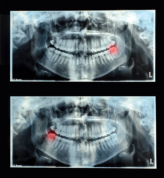 istock Panoramic dental x-ray  with superior upper wisdom tooth 494154214