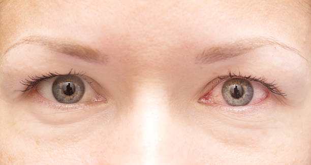 istock healthy and irritated eye 494156058
