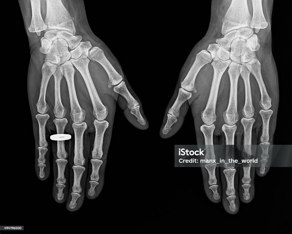 X-ray of hands X-ray image of left and right hand of a 68 year female.  Notice the wedding ring. 2015 Stock Photo