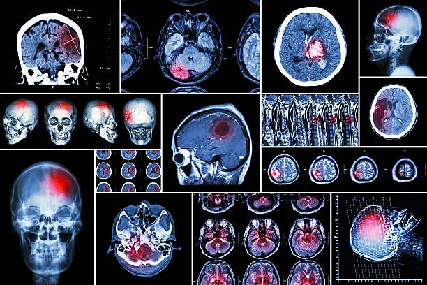 Set , Collection of brain disease stock photo