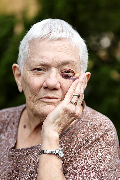 istock Pain of a black eye 494252938
