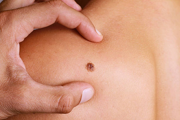 istock Dermatologist hands examines a birthmark of patient. 494257546
