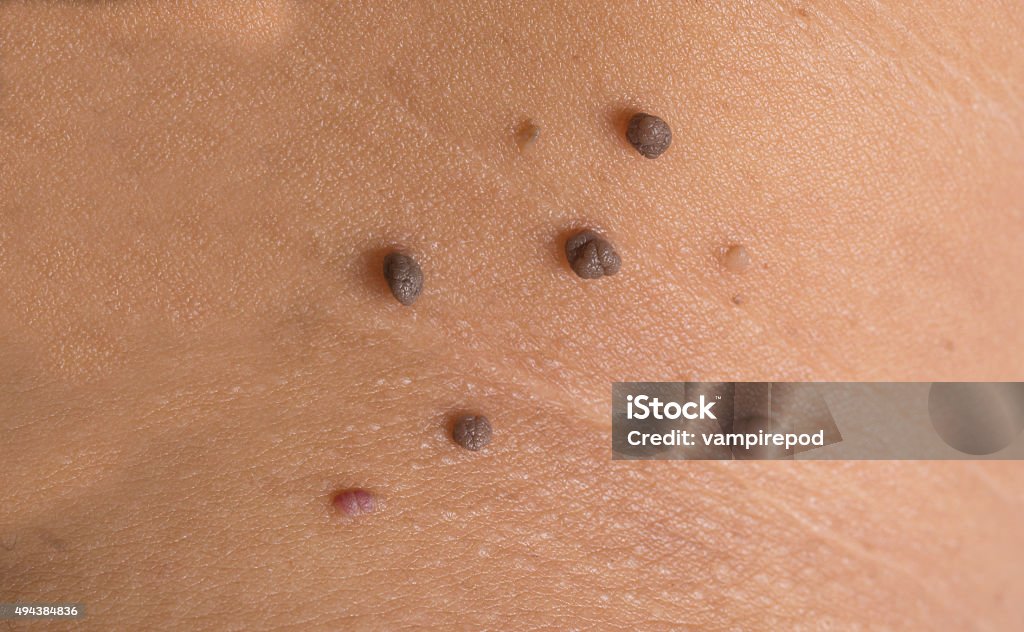 skin of a woman with moles Pimple Stock Photo