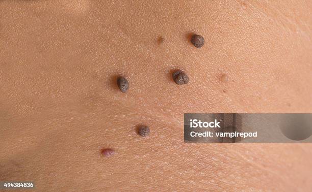 Skin Of A Woman With Moles Stock Photo - Download Image Now - Pimple, 2015, Adult