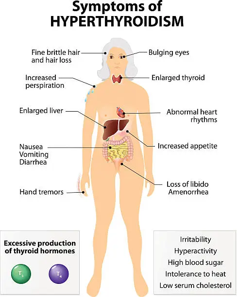 Vector illustration of Hyperthyroidism or over active thyroid. hyperthyreosis