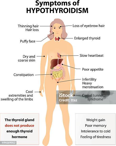 Inflammation Hypothyroïdienne Vecteurs libres de droits et plus d'images vectorielles de Inflammation hypothyroïdienne - Inflammation hypothyroïdienne, Symptome, Glande thyroïde