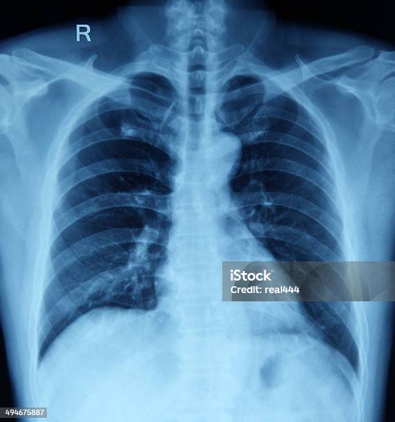 Рентгенография Грудной Клетки Изображение — стоковые фотографии и другие картинки Intercostal Space - Intercostal Space, Вертикальный, Внутренний орган человека
