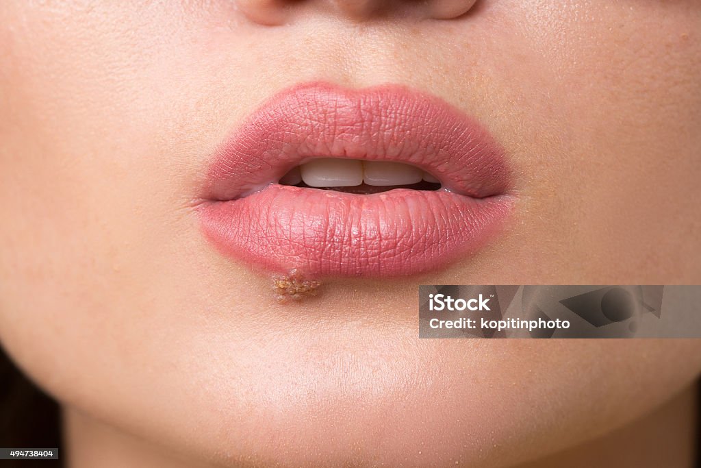 beautiful lips virus infected herpes beautiful sexy lips virus infected herpes. close-up Herpes Stock Photo