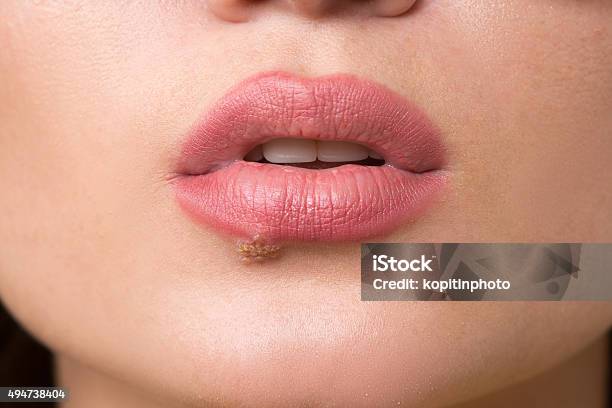 Beautiful Lips Virus Infected Herpes Stock Photo - Download Image Now - Herpes, 2015, Adult