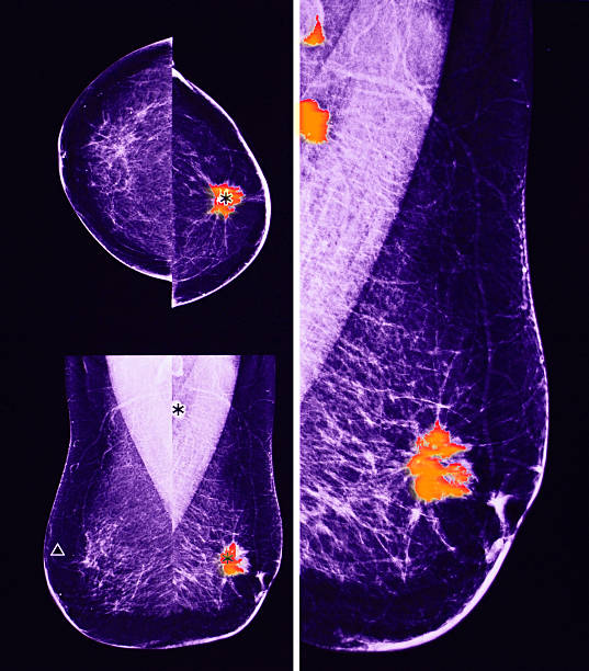istock mammography, breast cancer 494883374