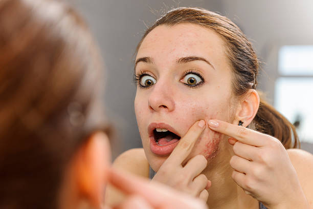 istock woman with acne on face 494955263