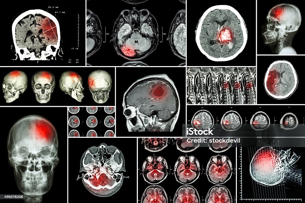 Set Collection de la maladie du cerveau - Photo de Tomographie axiale informatisée libre de droits