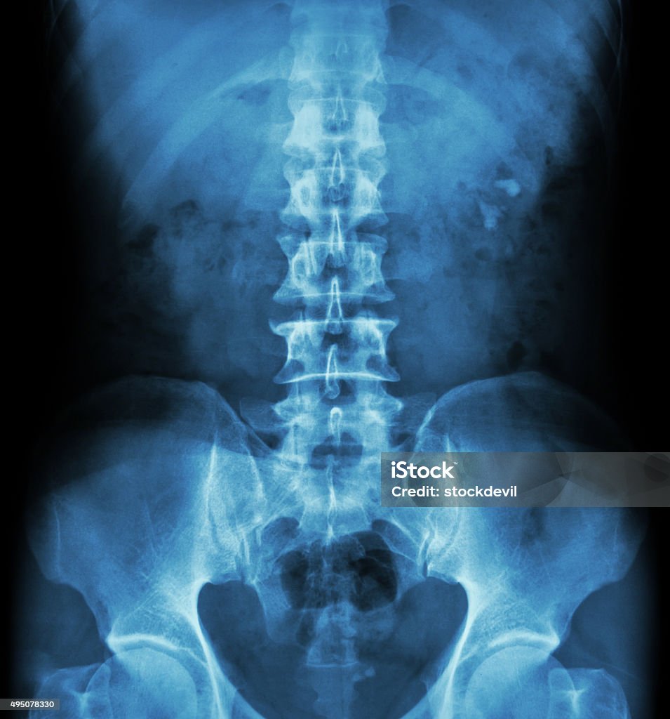 Kidney stone ( renal stone , renal calculi ) Kidney stone ( renal stone , renal calculi ) ( film x-ray KUB ( Kidney - Ureter - Bladder ) show left renal stone ) X-ray Image Stock Photo