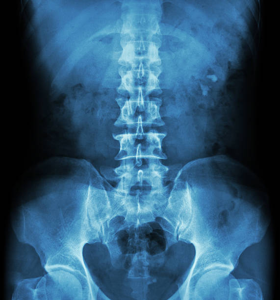 Kidney stone ( renal stone , renal calculi ) Kidney stone ( renal stone , renal calculi ) ( film x-ray KUB ( Kidney - Ureter - Bladder ) show left renal stone ) Pelvis stock pictures, royalty-free photos & images