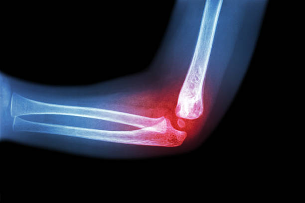 Rheumatoid arthritis , Gouty arthritis ( film x-ray child 's elbow with arthritis at elbow ) ( Side view , Lateral )