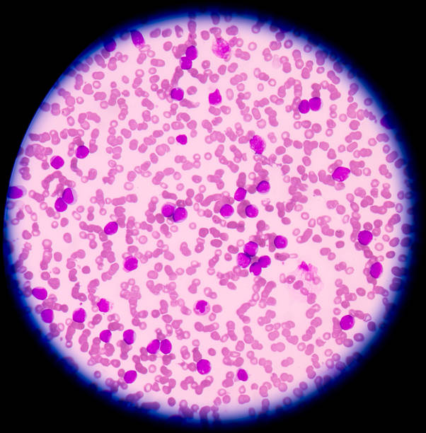 Acute myelogenous leukemia (AML).Most AML subtypes are distinguished from other related blood disorders by the presence of more than 20% blasts in the bone marrow.