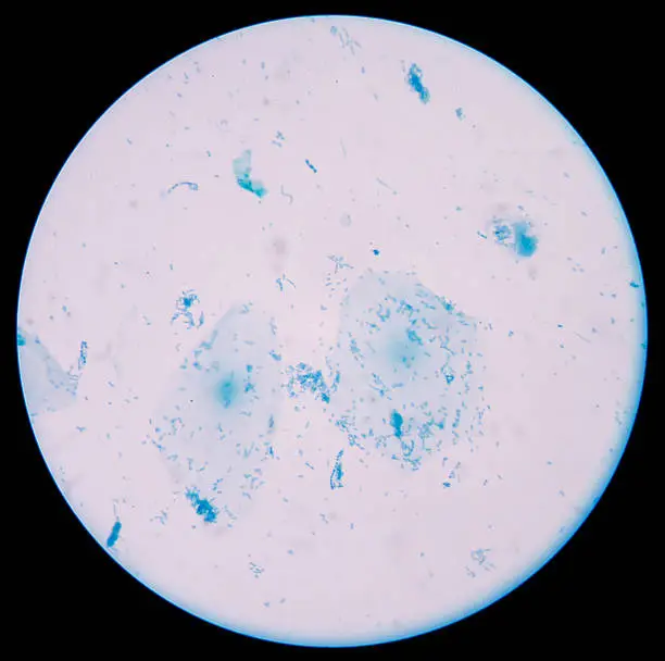 Photo of Gram positive cocci,gram stain.