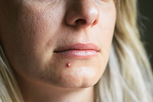istock Pimple on the womans face 495243316