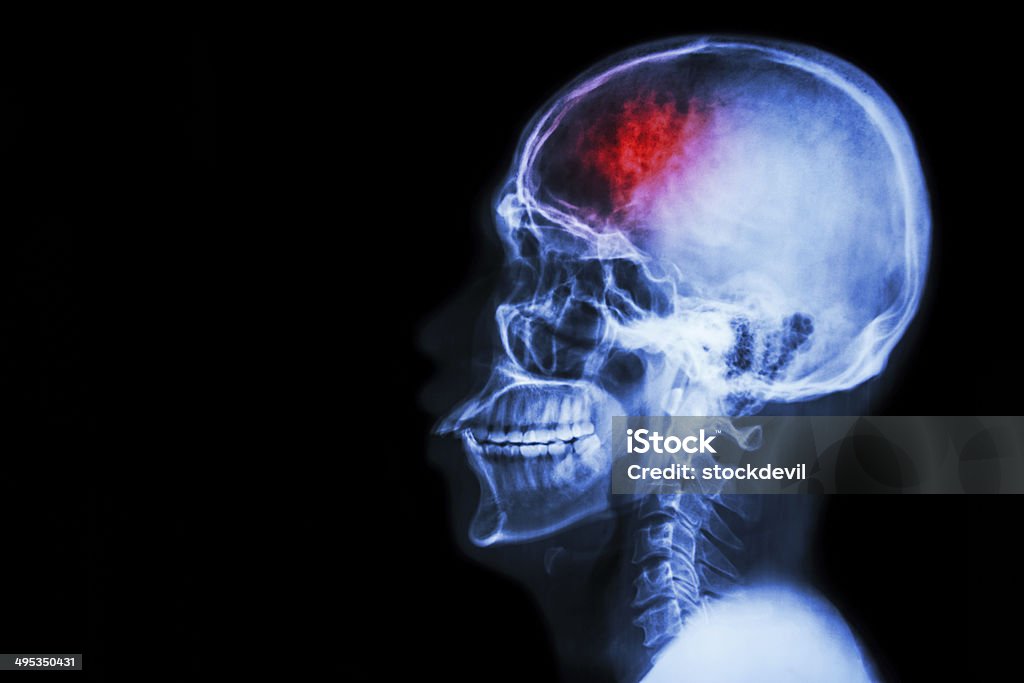 Stroke (cerebrovascular accident - 로열티 프리 부상 스톡 사진