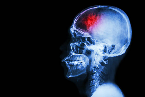 Stroke (cerebrovascular accident) stock photo