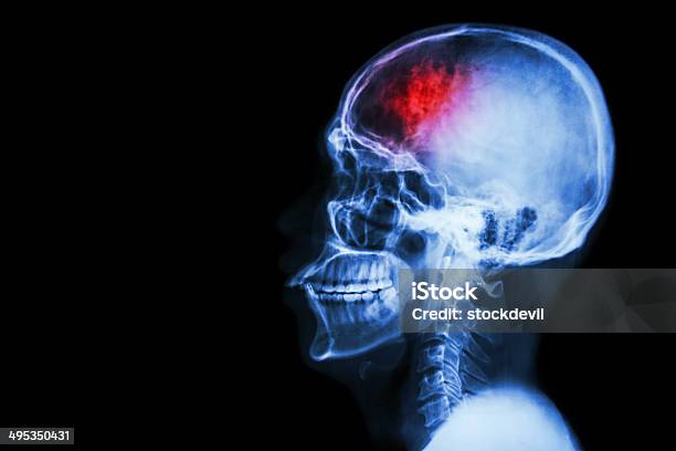 Stroke Stock Photo - Download Image Now - Physical Injury, Brain, Stroke - Illness