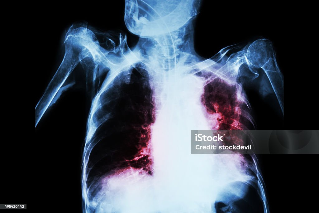 Pulmonar a tuberculose com falha Respiratória Aguda Grave - Foto de stock de Pneumonia royalty-free