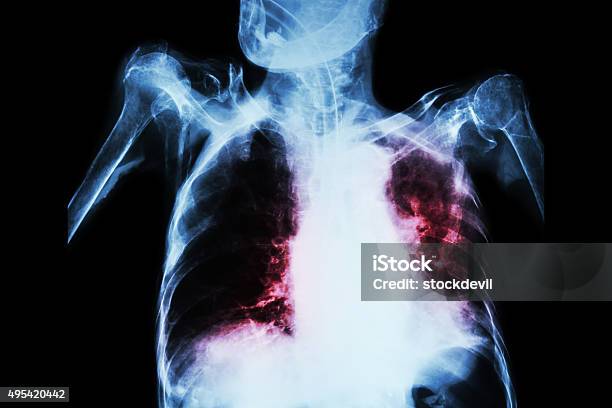 Foto de Pulmonar A Tuberculose Com Falha Respiratória Aguda Grave e mais fotos de stock de Pneumonia