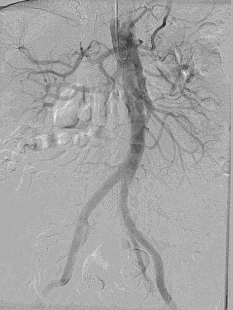 aortography addominale - roentgenogram foto e immagini stock