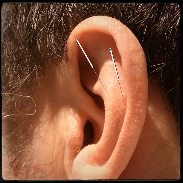 Photo of acupuncture
