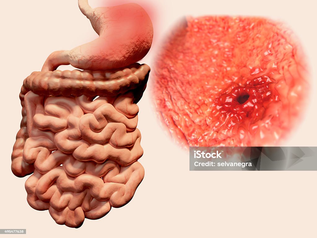 Stomach ulcer Peptic ulcer or stomach ulcer, is a break in the lining of the stomach, first part of the small intestine, or occasionally the lower esophagus Peptic Ulcer Stock Photo