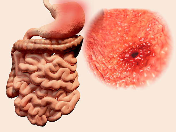 Stomach ulcer Peptic ulcer or stomach ulcer, is a break in the lining of the stomach, first part of the small intestine, or occasionally the lower esophagus stomach perforation stock pictures, royalty-free photos & images