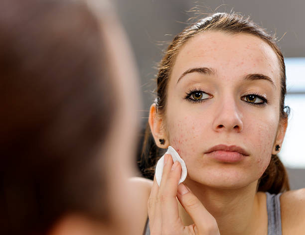 teenager with acne teenager portrait with acne on her face removing makeup with cotton pad. abscess stock pictures, royalty-free photos & images