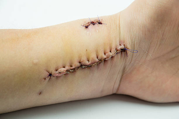 carcinoma della pelle di rimozione - wound sunburned scar physical injury foto e immagini stock