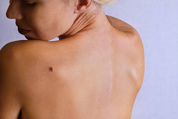 Young woman lookimg at birthmark on  back, skin. stock photo