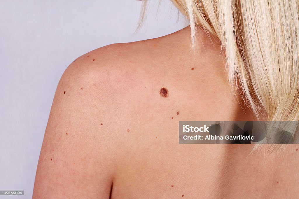Mujer joven con en birthmark sobre su espalda, de la piel. - Foto de stock de Lunar libre de derechos