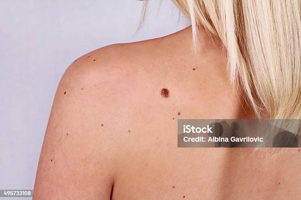 Mujer Joven Con En Birthmark Sobre Su Espalda De La Piel Foto de stock y más banco de imágenes de Lunar