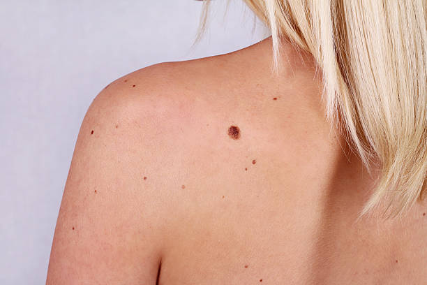 Young woman with at birthmark on her back, skin. stock photo
