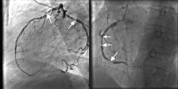 krankheit auf angiography multivessel sinus - human heart heart attack x ray image chest stock-fotos und bilder