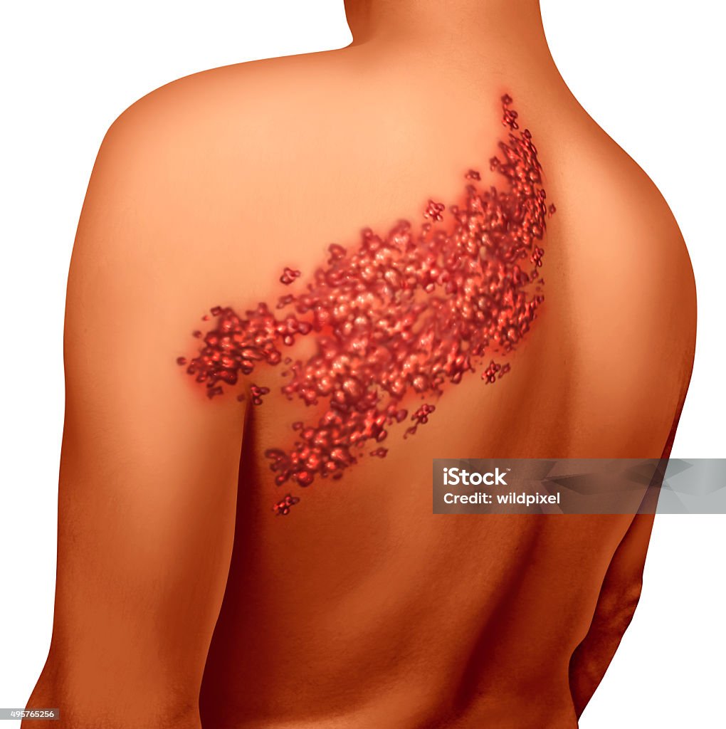 Shingles Disease Shingles disease viral infection concept as a medical illustration with skin blisters hives and sores on a human back torso as a health symbol for a painful rash condition. Shingles Stock Photo