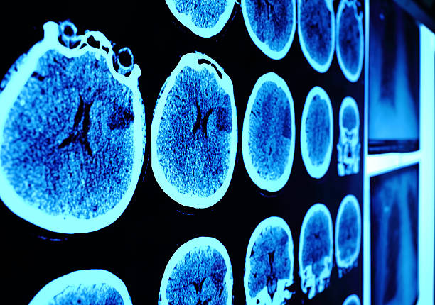 tomografía computarizada del cráneo imagen en la pared - mri scanner medical scan cat scan oncology fotografías e imágenes de stock