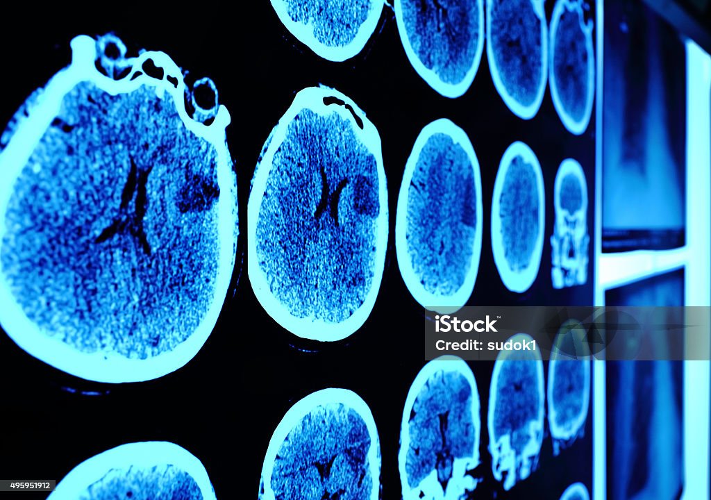 Skull CT scan picture on the wall Skull CT scan picture on the wall in perspective Brain Tumour Stock Photo