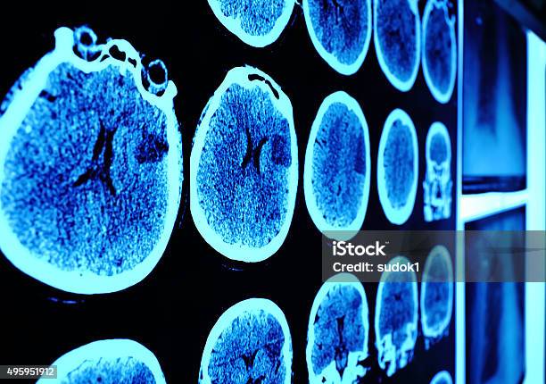 Skull Ct Scan Picture On The Wall Stock Photo - Download Image Now - Brain Tumour, Oncology, Cancer Cell