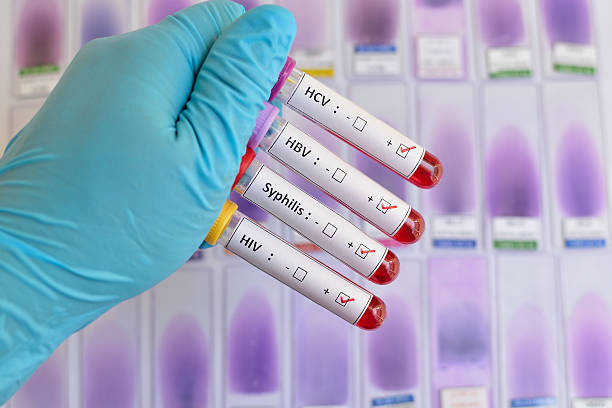 tm 에이즈바이러스, hbv, hcv, 매독 - sexually transmitted disease 뉴스 사진 이미지